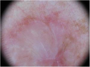 Imagen dermatoscópica de la tumoración de la Figura 4. Se trata de una tumoración con un componente palpable de coloración rosada. En este caso la presencia de retículo pigmentado en varias áreas de la lesión debe orientar el diagnóstico hacía una lesión melanocítica.