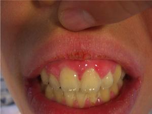 Lesiones hiperqueratósicas de aspecto verrucoso en el labio superior.