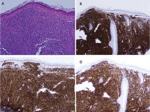 A) Biopsia de una lesión nodular. Infiltrado linfocitario dérmico compuesto por linfocitos de pequeño tamaño con núcleos hipercromáticos y redondeados, y con un citoplasma escaso (hematoxilina-eosina×20). B-D) Positividad para CD20 (B), BCL-2 (C) y PAX-5 (D) del infiltrado linfocitario.