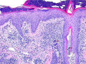 Hiperplasia epidérmica de aspecto reactivo con colección de neutrófilos intracórneos. En la dermis destaca la presencia de un infiltrado linfohistiocitario y ectasia vascular, junto con la presencia de figuras compatibles con Demodex folliculorum (flechas) (H&E 20×).
