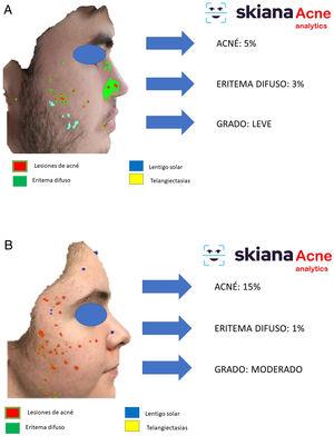 Aplicación para Smartphone SkianaCare®: evaluación automatizada de fotoenvejecimiento de la piel. A y B. Ejemplo de 2 mujeres de la misma edad con diferente grado de severidad en términos de fotoenvejecimiento.