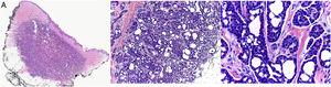 A) Imagen panorámica de la biopsia que muestra una proliferación parcialmente circunscrita en dermis que se extiende de forma focal a tejido celular subcutáneo (H-E, ×10). B) La neoplasia está compuesta por múltiples islotes interconectados de células epiteliales basófilas que forman pequeños espacios quísticos redondos y vacíos, adquiriendo una imagen «en colador» (H-E, ×40). C) Los núcleos de las células neoplásicas son grandes y moderadamente pleomórficos. En algunos espacios quísticos se observa la presencia de puentes intraluminales y la formación de micropapilas (H-E, ×400).