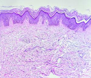 Hiperqueratosis y discreta acantopapilomatosis. Depósitos de mucina entre haces de colágeno a nivel de la dermis. (H&E 100x).