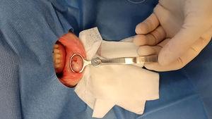 Biopsia de la mucosa labial en un paciente con sospecha de queilitis granulomatosa.
