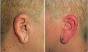 Eritema y tumefacción de la oreja izquierda (B), sin afectación de la oreja contralateral (A).