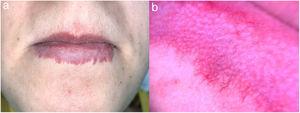 Malformación capilar del labio. a. Paciente 2. b Obsérvese el borde irregular «en dientes de sierra» en dermatoscopia.