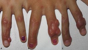 Caso 1. A) Placas induradas en tercer dedo de mano derecha. B) Recidiva en cuarto dedo tras intervención. C) Respuesta parcial tras un año de infiltración de esteroides y observación clínica.