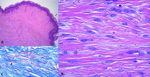 Hallazgos histopatológicos. A) Proliferación fusocelular que ocupa el espesor completo de la dermis (hematoxilina-eosina, ×4). B) Detalle a mayor aumento de las células fusiformes (hematoxilina-eosina, ×40). C) Inclusiones intracelulares realzadas mediante tinción tricrómica de Masson, ×40.