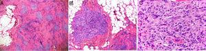 Imagen histológica de tumor fibrohistiocitario plexiforme. A) Hematoxilina-eosina ×4. B) Hematoxilina-eosina ×10. C) Hematoxilina-eosina ×200.