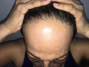 Alopecia frontotemporal con retracción de la línea de implantación.