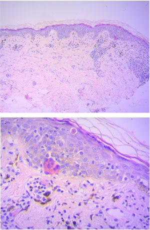 Dermatitis vacuolar de interfase con presencia de melanófagos en dermis(H-E, 10x y 40x).