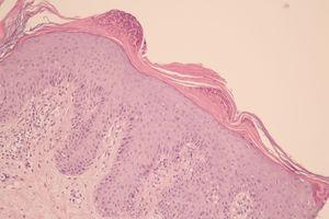 Estructura cutánea compuesta por epidermis acantósica irregular e hiperqueratosis con paraqueratosis. Se observan microabscesos de Munro en la capa córnea (H&E).