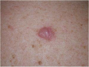 Clinical image of a desmoplastic melanoma (DM) in a 53-year-old woman who presented with a firm, pink interscapular tumor initially thought to be a keloid lesion. Biopsy showed a pure DM with a thickness of 8.5 mm.