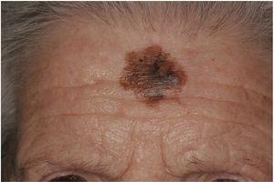 Clinical image of a desmoplastic melanoma (DM) associated with lentigo maligna (LM) in an 89-year-old woman who presented with a lesion on her forehead suggestive of LM. Excision showed a DM with a thickness of 2.95 mm.