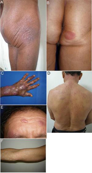 Clinical characteristics of the most common presentations in the series: classical, folliculotropic, and hypopigmented MF. A, MF patches in a zone unexposed to the sun, with epidermal atrophy. B, MF presenting as an erythematous, infiltrated plaque. C, MF presenting as multiple, erythematous, ulcerated tumors. D, Folliculotropic MF with erythematous plaques and other lesions resembling epidermoid cysts. E, Folliculotropic MF with well-defined infiltrated plaques on the forehead. F, Hypopigmented MF with patches on the upper right arm. MF indicates mycosis fungoides.