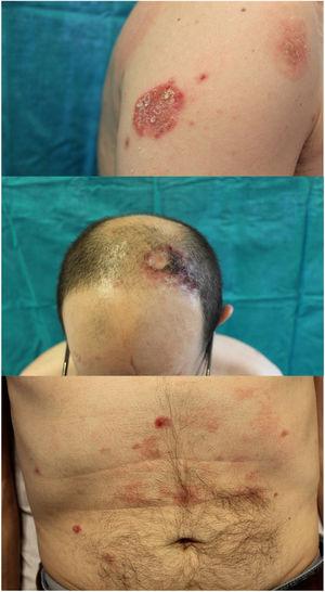 Diffuse, ring-shaped, polymorphic, erythematous–desquamative lesions.