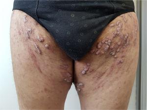Ostraceous erythematous–desquamative plaques on distension striae in both groins.