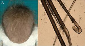 A, Hypotrichosis in a girl with loose anagen hair. B, Twisted anagen roots and ruffling in the inner sheath of the hair follicle.