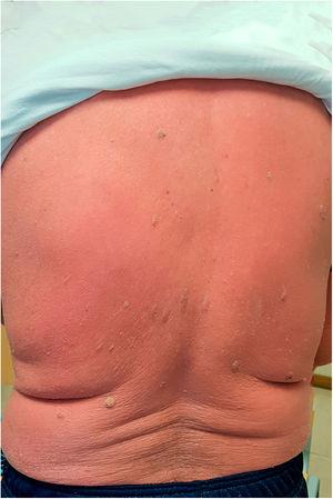 Diffuse erythema on a 71-year-old man's back, on the few days prior to admission.