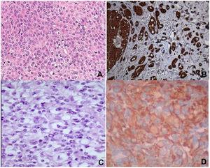 A) Staining with hematoxylin–eosin showing clear cells, epithelioid cells, and spindle cells. B) Spindle cells expressing S-100. C) Staining with hematoxylin-eosin showing spindle cells with a clear cytoplasm and minimal cytologic atypia. D) Cells expressing vimentin. Original magnification for all images, 40×.
