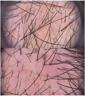 Dermoscopy images with polarized light (obtained using the Fotofinder® digital dermatoscope). Top panel: 20× magnification. Bottom panel: 30× magnification. Focal alopecia, broken hairs of uniform length, short, vellus regrowth hair, and yellow spots.