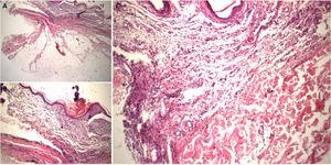 Skin biopsy. H&E. (A) Abundant mature adipose tissue in depth, compressing the overlying dermis. (B) Thin epidermis with orthokeratotic hyperkeratosis. (C) Absence of hair follicles and adnexal structures.