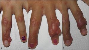 Patient 1. A, Indurated plaques on the third finger of the right hand. B, Recurrence on the fourth finger after intervention. C, Partial response after 1 year of steroid infiltration and clinical observation.