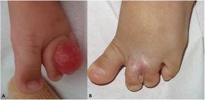 Patient 2. A, Indurated pink nodule between the second and third toes of the left foot. B, Recurrence several months after complete excision and digital amputation.