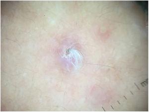 Dermoscopic examination shows a central whitish hair plug surrounded by a white-pink area.