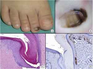 Congenital subungual melanocytic nevus. A, A 15-month-old girl consulted for longitudinal melanonychia affecting the second toe of the right foot. The clinical examination revealed a wide band of longitudinal melanonychia, with various lines with pigmentation of different colors, which extended to the proximal nail fold. B, Dermoscopy confirms the clinical findings: a band of almost total melanonychia can be seen, with lines of different thicknesses and pigment colors. Also visible is light pigmentation in both the proximal nail fold and the lateral nail fold. All of these signs would be considered cause for alarm in an adult. C, Oblique section of the nail and surrounding tissues showing acral epithelium with a proliferation of melanocytes in the basal layer of the epithelium arranged in nests, with no atypical cellular characteristics. D, Staining with HMB45 confirms the proliferation to be melanocytic, as well as its distribution in nests.