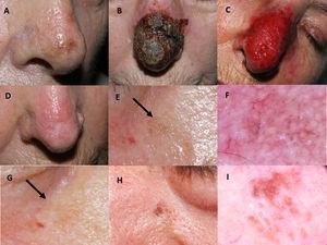 Imiquimod treatment in a lentigo maligna located on the nasal tip in a 77-year-old female (patient 1, see Table 1): (A) Pretreatment; (B) Intense inflammatory reaction during treatment with a thick black hemorrhagic crust; (C) Intense erythema and edema after removing scabs; (D) Resolution following the end of treatment. A residual scar due to the previous skin biopsy is present. 76-year-old female, who had received treatment with 5% imiquimod in monotherapy for a lentigo maligna lesion on her right cheek with self-limited postinflammatory hyperpigmentation (patient 2, see Table 1): (E) Slight gray pigmentation, black arrow; (F) In this dermoscopic photograph, grayish annular–granular structures around the follicles (peppering); (G) Spontaneous disappearance of pigmentation after several weeks, black arrow. 76-year-old man who had a relapse of lentigo maligna at 2 months after finishing treatment with imiquimod 5% in monotherapy (patient 7, see Table 1): (H) Mottled brown pigmentation of irregular distribution on his left paranasal region; (I) Dermoscopic photograph, showing asymmetrical perifollicular brown pigmentation.