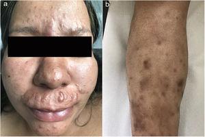 (a) Multiple erythematous and pigmented papular lesions symmetrically distributed and diffuse infiltration of the malar regions. (b) Subcutaneous nodular lesions with overlying hyperpigmentation on the shin.