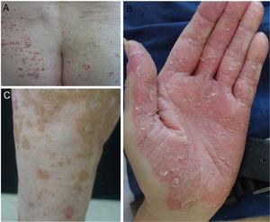 Patients in our department with psoriasis due to anti-PD1/anti-PDL1. (A) Guttate psoriasis. (B) Palmoplantar psoriasis. (C) Psoriasis plaques and vitiligo.