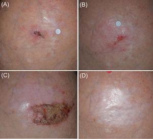 Panel (A): Initial presentation of the Tumor 1 in the mid-scalp (Patient 1). The tumor had a maximal diameter of 20mm and was a relapse from a previous surgery 10 years ago. Panel (B): After the initial ‘7/2 treatment cycle’ (7-weeks of imiquimod and cryosurgery at days 24 and 28 of the treatment cycle) a partial response of the tumor was achieved. Panel (C): The tumor area after the second treatment cycle of 5 weeks imiquimod and 1 cryosurgery session (‘5/1 cycle’). Panel (D): Sustained complete clearance at 30-month follow up.