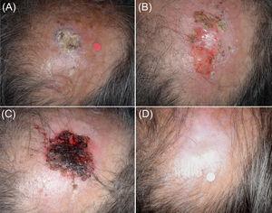 Panel (A). Initial presentation of the Tumor 6 (Patient 3) in the midscalp. An intense inflammatory response after the first cryosurgery session of the ‘7/2 treatment cycle’ Panel (B). Tumor rests at the end of the first treatment cycle. Only partial response was noted. Panel (C). The tumor area at the end of the second treatment cycle. Panel (D) The tumor site at the 12-month follow-up. The healing process is excellent in an area that normally requires complex surgical reconstruction procedures.