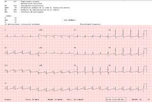 Electrocardiograma (ECG) en el que se observa prolongación del intervalo QT (QTc 510 ms), descenso no significativo del segmento ST y crecimiento de onda P.