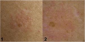 Reacción dudosa. 1) Imagen clínica, 2) imagen dermatoscópica, áreas de eritema no limitado a áreas perifoliculares en <50% de la cámara.