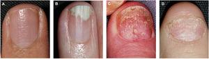 Clinical features of nail matrix psoriasis. A, Pitting. B, Onycholysis with pseudoleukonychia. C, Nail dystrophy or crumbling and red spots in the lunula. D, Trachyonychia.