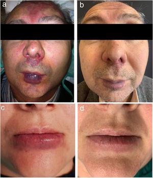 Images before treatment (left side) and 3 weeks after the last treatment (right side). a, b. Refers to patient 4. c, d. Refers to patient 6.