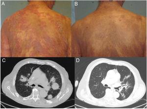 Clinical and radiological response of 2 patients treated with brentuximab. A, Skin lesions in Patient 1 before starting systemic treatment. B, Clinical cutaneous response 6 weeks after starting treatment, showing a decrease in erythema and infiltration, and in the extent of the lesions. C, Axial section of contrast computed tomography scan of the chest. Tumor masses in both lung fields correspond to a proliferation of CD4+/CD30+ lymphocytes. D, Complete disappearance of the tumor masses after eighth infusion of brentuximab.