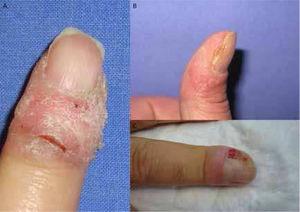 Clinical presentation of nail squamous cell carcinoma. Erythematous scaly plaques (A and B) and granulation-like tissue (C) located around the nail.