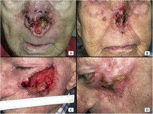 Casos 12 (A y B) y 2 (C y D). (A y B): cSCC localmente avanzado en la nariz de una mujer anciana. Existe una reducción drástica de la masa tumoral tras solo 2 ciclos de cemiplimab (B). (C y D): cSCC localmente avanzado en la mejilla izquierda de un hombre anciano. Antes de iniciarse la terapia, el paciente presentó un gran tumor ulcerado (C). Tras 10 ciclos, el paciente mostró una respuesta completa al tratamiento, con desaparición completa de la masa tumoral y exposición ósea maxilar secundaria.
