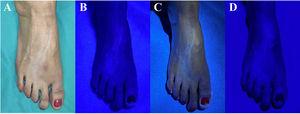 Linear cutaneous hypopigmentation following local injection of corticosteroids in patient 1. A) Clinical presentation of the lesions under ambient lighting. B) Blue coloring of the lesions using the conventional Wood's lamp. C) Bluish-white coloration of the lesions using the 365-nm LED torch, with optimum demarcation of the lesions. D) Blue coloring of the lesions using the light emitted by the smartphone, with suboptimal demarcation of the lesions due to excess brightness.