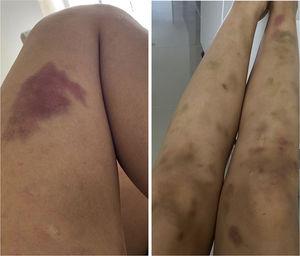 Bruises, spontaneous ecchymoses, and postinflammatory hyperpigmentation predominantly on extensor surfaces of the lower extremities.