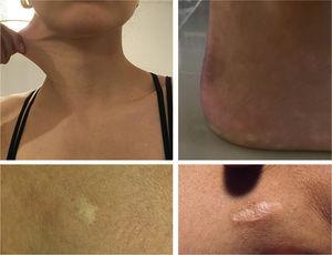 Hyperelasticity of the skin, stretching beyond 3cm in the neck (superior left); Pyezogenic papules (superior right); Atrophic scars (bottom).