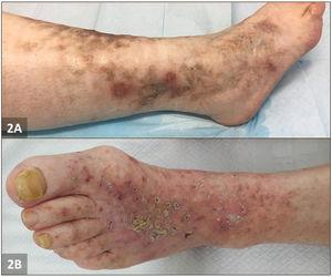 Livedoid vasculopathy, clinical picture: (A) Patient 1, mottled skin and punched-out ulcers surrounded by purpuric erythema and hyperpigmentation. (B) Patient 2, multiple pinpoint ulcerations and crusts on a livedoid base.