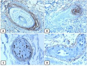 Immunohistochemical expression of CD10 in the normal skin. Positive cytoplasmic CD10 in peri-adnexal mesenchymal spindle cells (A, ×400), hair papilla of vellus follicles (B, ×400). Some nerve axons (C, ×400), and myoepithelial cells of the sweet glands (D, ×400).