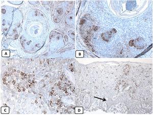 Immunohistochemical expression of CD10, and BCL 2 proteins in basal cell carcinoma. (A and B) CD10 cytoplasmic staining in BCC cells with more positivity in the peripheral cells (A, ×100 and B, ×400, the inset shows cytoplasmic and membranous CD10, ×400). (C and D) Positive cytoplasmic BCL2 expression in BCC especially among the peripheral cells (D, ×400). Reduced BCL2 expression in the infiltrative areas is noted (E, ×400).