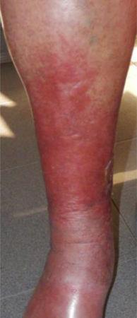 Correlation Between Cutaneous Manifestations and Functional Alterations ...