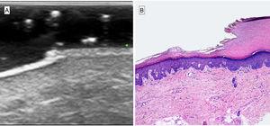 Correlation between ultrasound and histologic findings. A, B-mode ultrasound image, 22mHz. Area of abrupt epidermal thinning, sloping downward, with structural loss in a double hyperechogenic layer of acral skin. The image is similar to the stair-like sign. SLEB (a subepidermal low-echogenic band) can be observed under the affected epidermis. B, Histopathology shows an abrupt depression in the epidermis due to corneal layer thinning and shedding. The high correlation between ultrasonography and histology is evident.